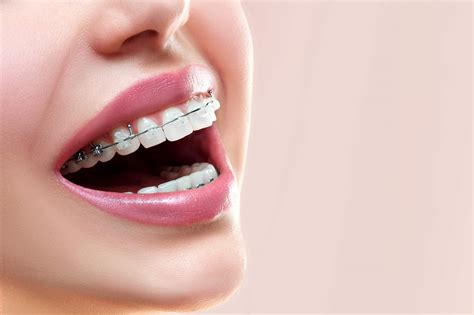 metal brackets dental|metal braces before and after.